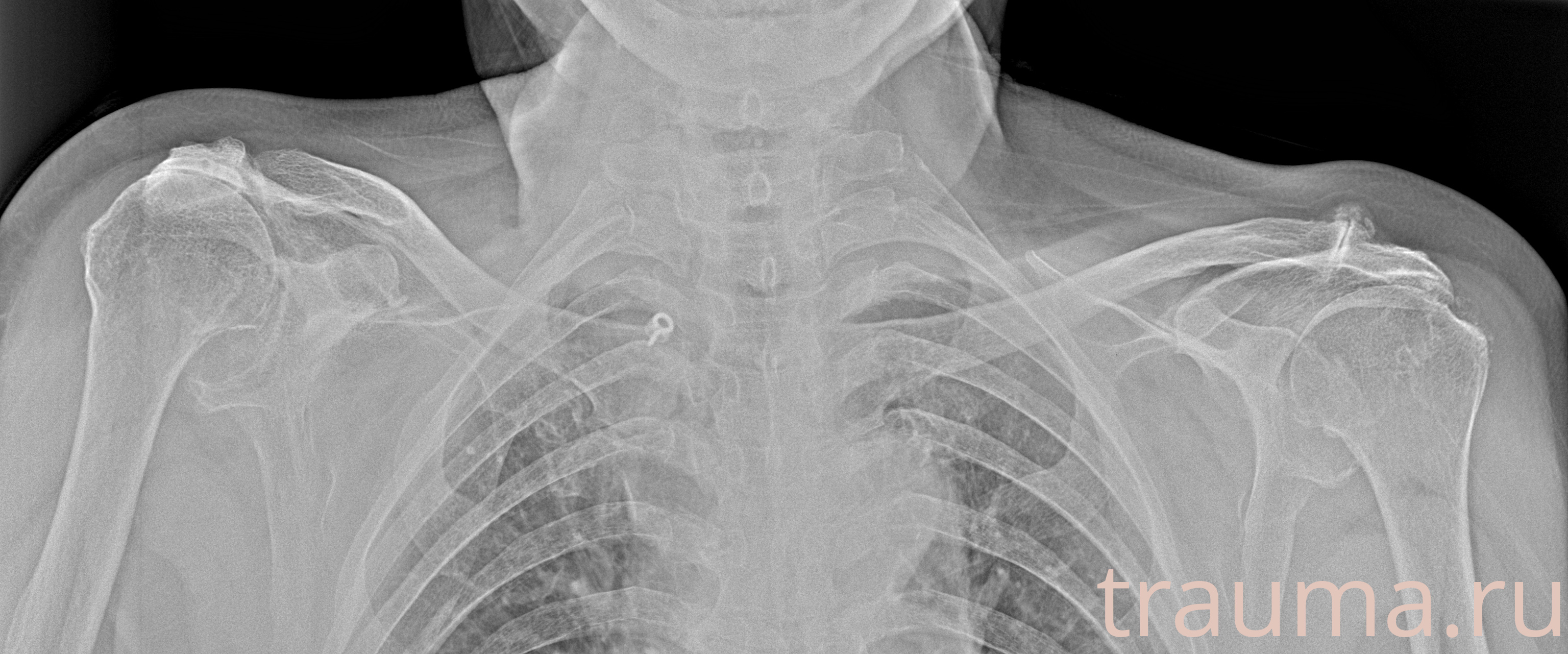 Рентген на дому: по вашему адресу приезжает врач-рентгенолог, травматолог-ортопед с мобильным рентгеновским аппаратом, проводит диагностику травмы или заболевания, делает необходимые рентгенограммы, дает рекомендации по дальнейшему лечению. Получить качественные снимки в домашних условиях возможно благодаря уникальной методике, разработанной МосРентген Центром для института  Склифосовского