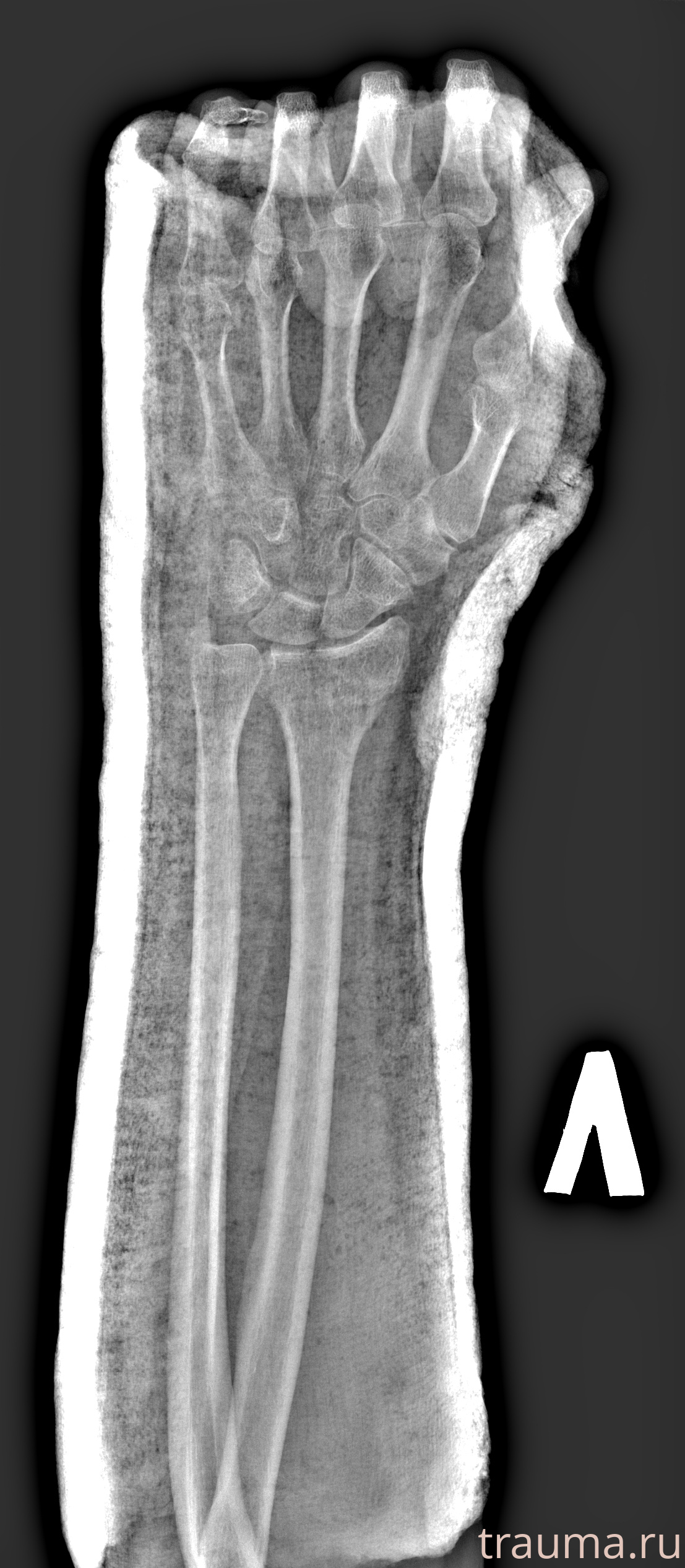 Рентген на дому: по вашему адресу приезжает врач-рентгенолог, травматолог-ортопед с мобильным рентгеновским аппаратом, проводит диагностику травмы или заболевания, делает необходимые рентгенограммы, дает рекомендации по дальнейшему лечению. Получить качественные снимки в домашних условиях возможно благодаря уникальной методике, разработанной МосРентген Центром для института  Склифосовского