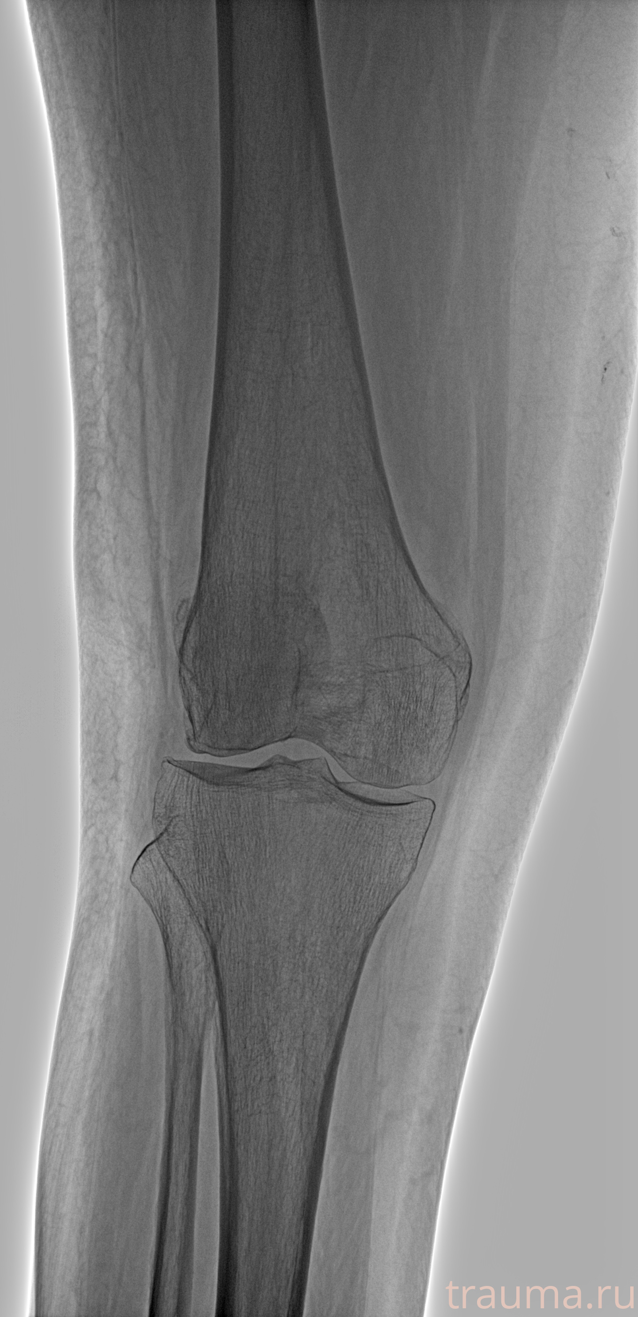 Рентген на дому: по вашему адресу приезжает врач-рентгенолог, травматолог-ортопед с мобильным рентгеновским аппаратом, проводит диагностику травмы или заболевания, делает необходимые рентгенограммы, дает рекомендации по дальнейшему лечению. Получить качественные снимки в домашних условиях возможно благодаря уникальной методике, разработанной МосРентген Центром для института  Склифосовского
