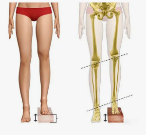  Несоответствие в длине нижних конечностей  у пациентов с коксовертабельным синдромом