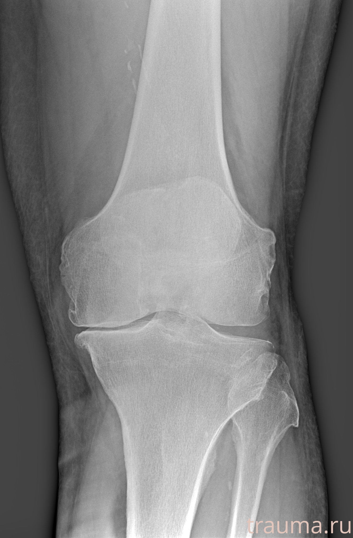 Рентген на дому: по вашему адресу приезжает врач-рентгенолог, травматолог-ортопед с мобильным рентгеновским аппаратом, проводит диагностику травмы или заболевания, делает необходимые рентгенограммы, дает рекомендации по дальнейшему лечению. Получить качественные снимки в домашних условиях возможно благодаря уникальной методике, разработанной МосРентген Центром для института  Склифосовского