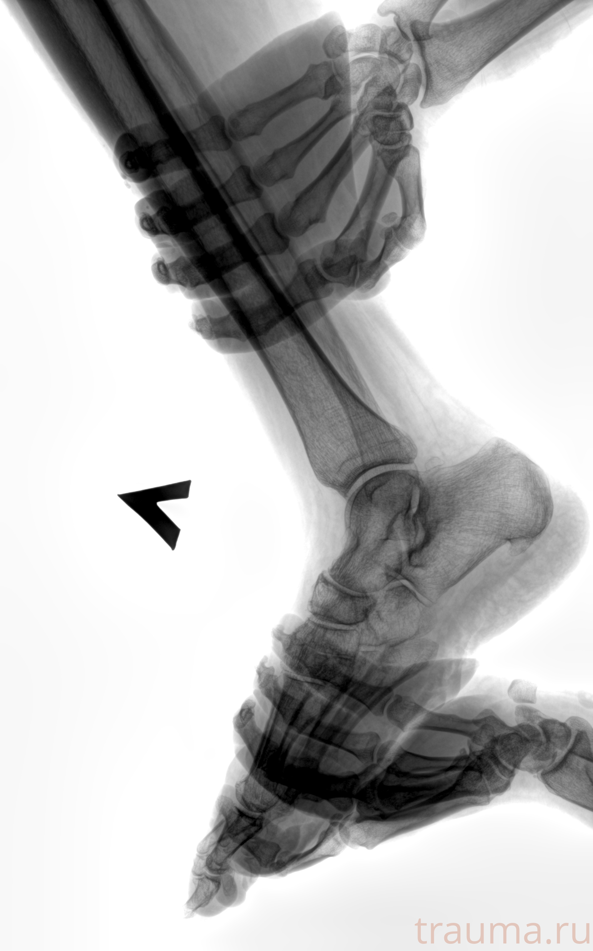 Рентген на дому: по вашему адресу приезжает врач-рентгенолог, травматолог-ортопед с мобильным рентгеновским аппаратом, проводит диагностику травмы или заболевания, делает необходимые рентгенограммы, дает рекомендации по дальнейшему лечению. Получить качественные снимки в домашних условиях возможно благодаря уникальной методике, разработанной МосРентген Центром для института  Склифосовского