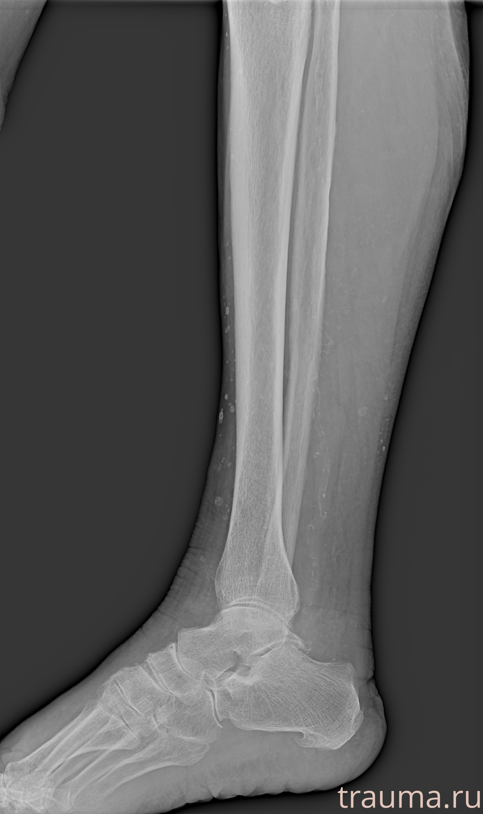 Рентген на дому: по вашему адресу приезжает врач-рентгенолог, травматолог-ортопед с мобильным рентгеновским аппаратом, проводит диагностику травмы или заболевания, делает необходимые рентгенограммы, дает рекомендации по дальнейшему лечению. Получить качественные снимки в домашних условиях возможно благодаря уникальной методике, разработанной МосРентген Центром для института  Склифосовского