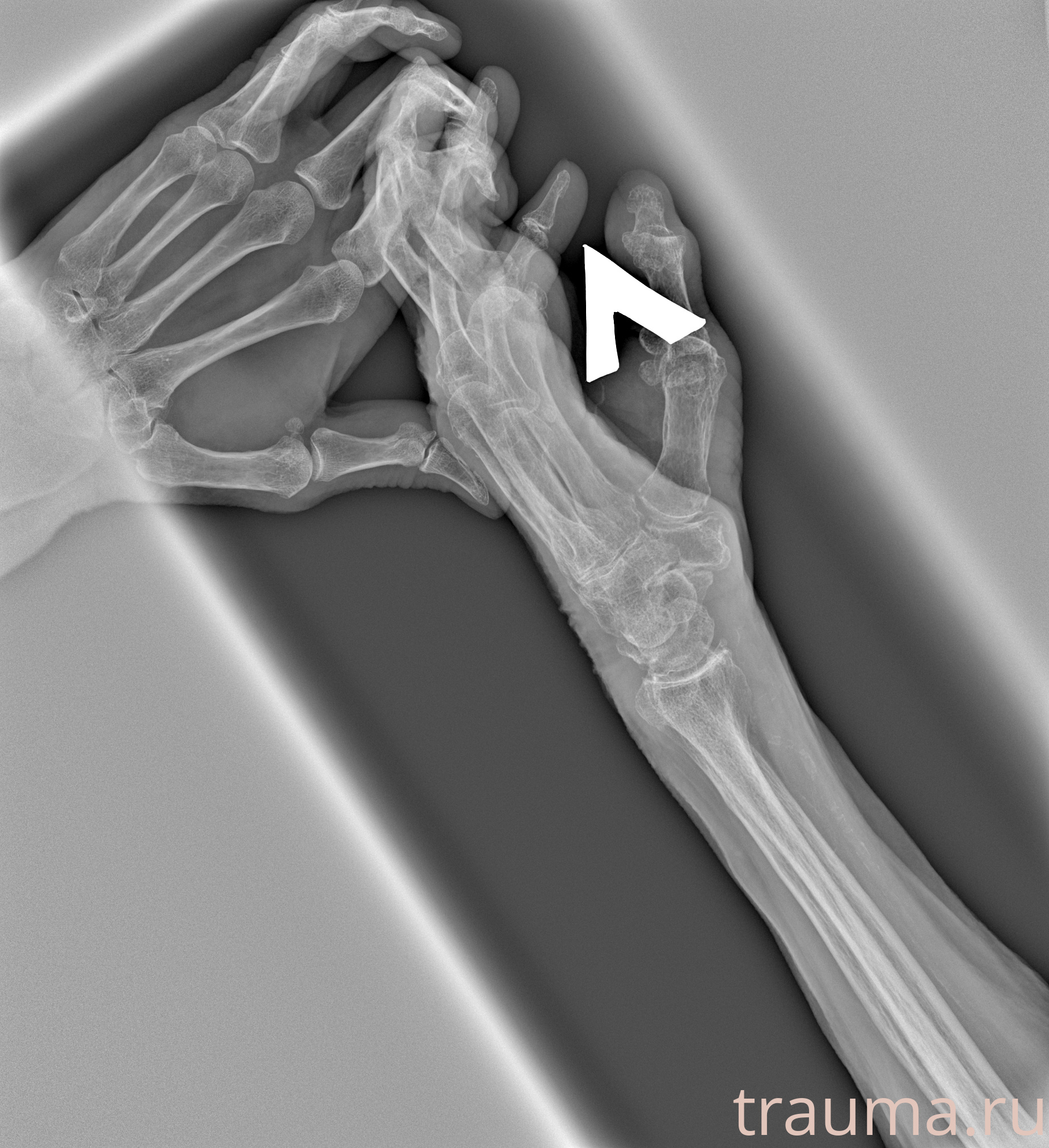 Рентген на дому: по вашему адресу приезжает врач-рентгенолог, травматолог-ортопед с мобильным рентгеновским аппаратом, проводит диагностику травмы или заболевания, делает необходимые рентгенограммы, дает рекомендации по дальнейшему лечению. Получить качественные снимки в домашних условиях возможно благодаря уникальной методике, разработанной МосРентген Центром для института  Склифосовского