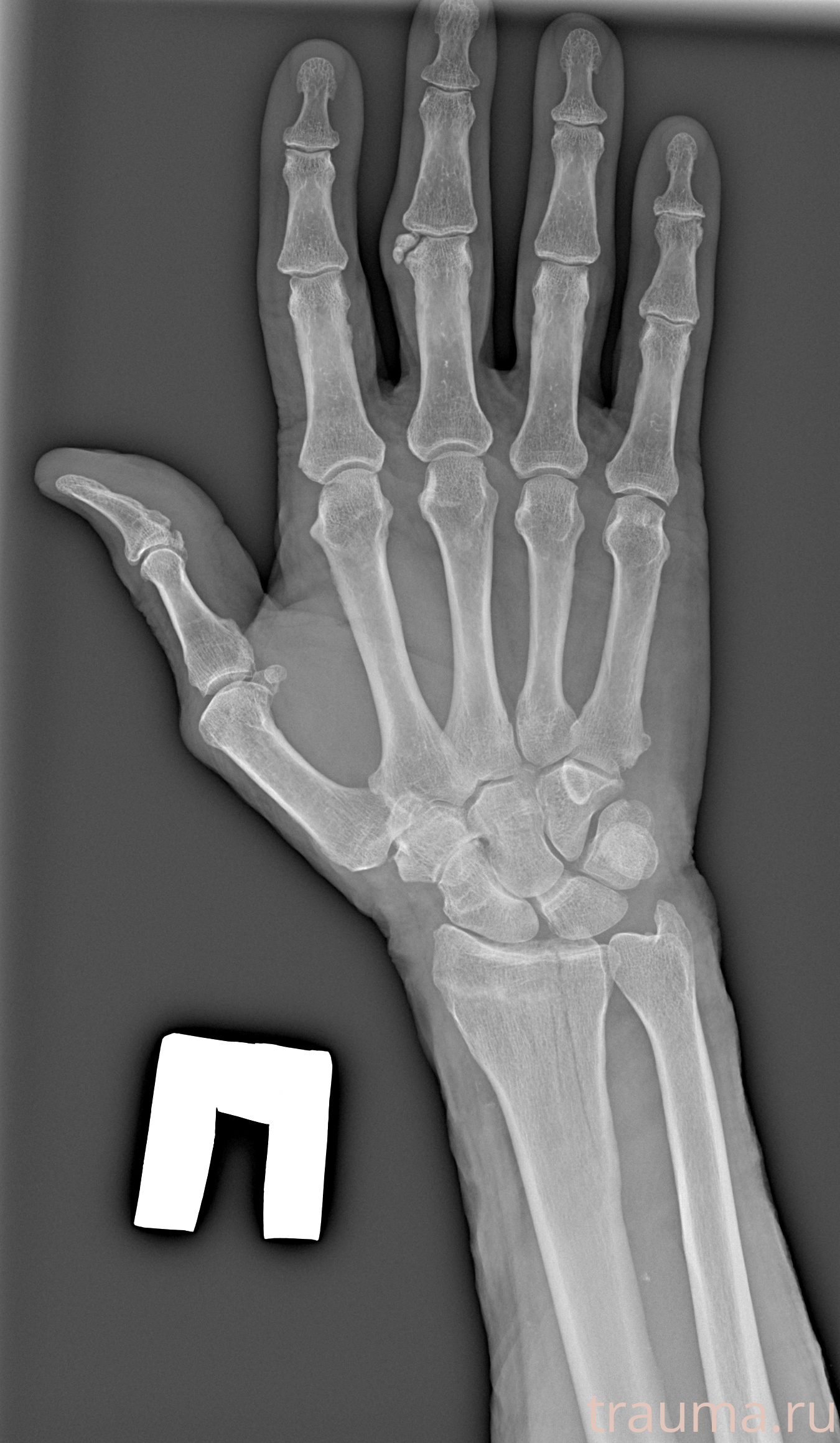 Рентген на дому: по вашему адресу приезжает врач-рентгенолог, травматолог-ортопед с мобильным рентгеновским аппаратом, проводит диагностику травмы или заболевания, делает необходимые рентгенограммы, дает рекомендации по дальнейшему лечению. Получить качественные снимки в домашних условиях возможно благодаря уникальной методике, разработанной МосРентген Центром для института  Склифосовского