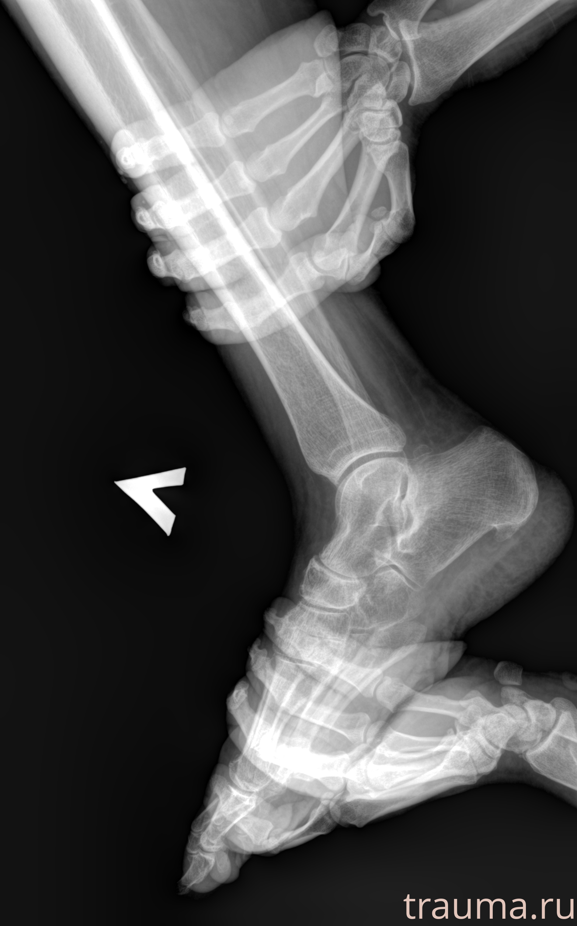 Рентген на дому: по вашему адресу приезжает врач-рентгенолог, травматолог-ортопед с мобильным рентгеновским аппаратом, проводит диагностику травмы или заболевания, делает необходимые рентгенограммы, дает рекомендации по дальнейшему лечению. Получить качественные снимки в домашних условиях возможно благодаря уникальной методике, разработанной МосРентген Центром для института  Склифосовского