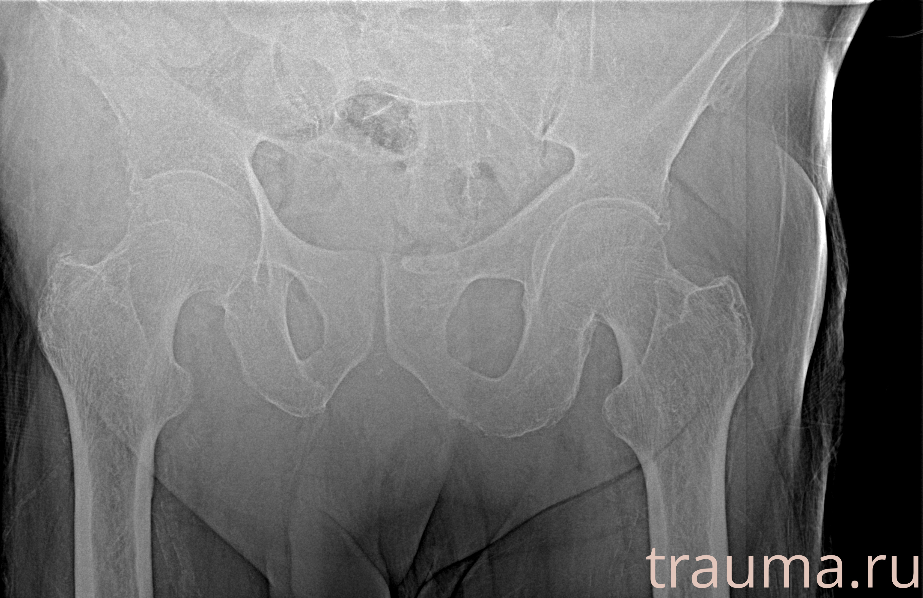 Рентген на дому: по вашему адресу приезжает врач-рентгенолог, травматолог-ортопед с мобильным рентгеновским аппаратом, проводит диагностику травмы или заболевания, делает необходимые рентгенограммы, дает рекомендации по дальнейшему лечению. Получить качественные снимки в домашних условиях возможно благодаря уникальной методике, разработанной МосРентген Центром для института  Склифосовского