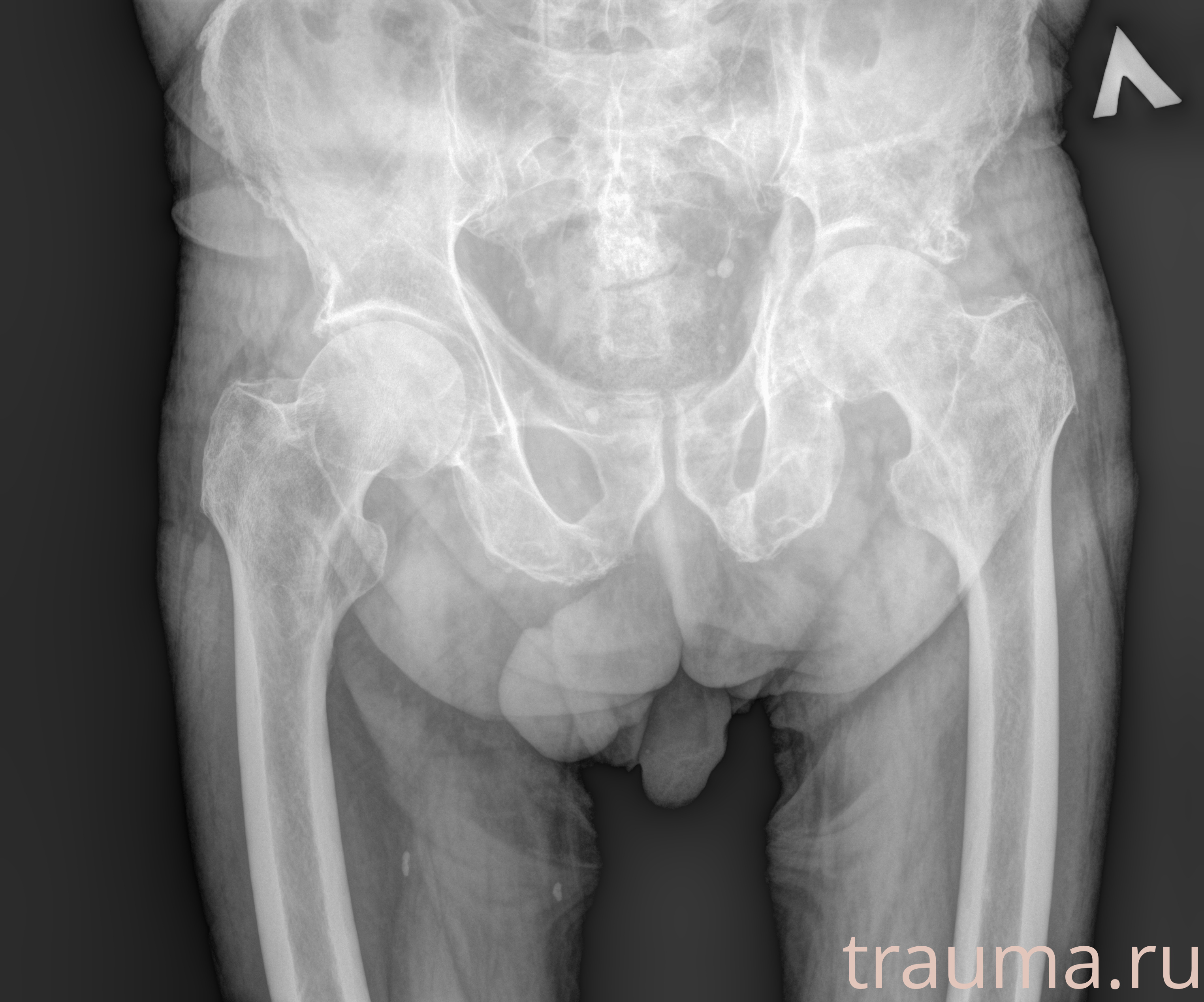 Рентген на дому: по вашему адресу приезжает врач-рентгенолог, травматолог-ортопед с мобильным рентгеновским аппаратом, проводит диагностику травмы или заболевания, делает необходимые рентгенограммы, дает рекомендации по дальнейшему лечению. Получить качественные снимки в домашних условиях возможно благодаря уникальной методике, разработанной МосРентген Центром для института  Склифосовского