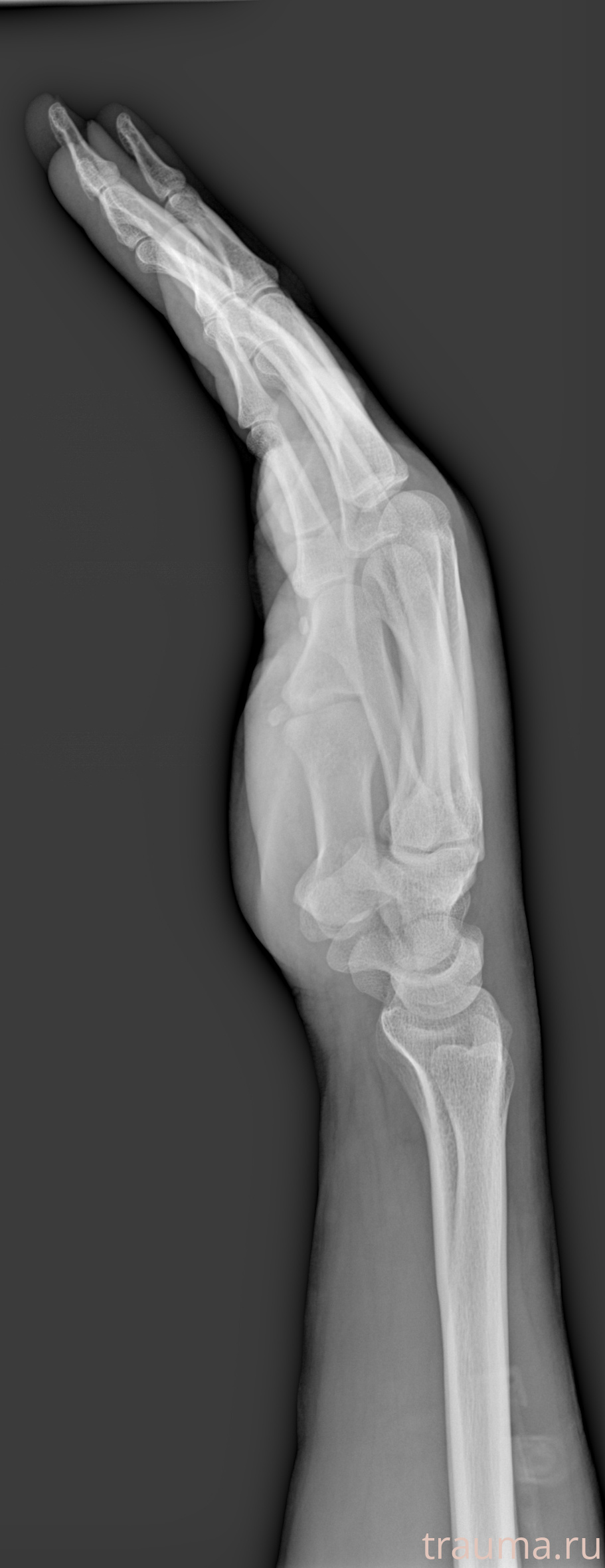 Рентген на дому: по вашему адресу приезжает врач-рентгенолог, травматолог-ортопед с мобильным рентгеновским аппаратом, проводит диагностику травмы или заболевания, делает необходимые рентгенограммы, дает рекомендации по дальнейшему лечению. Получить качественные снимки в домашних условиях возможно благодаря уникальной методике, разработанной МосРентген Центром для института  Склифосовского