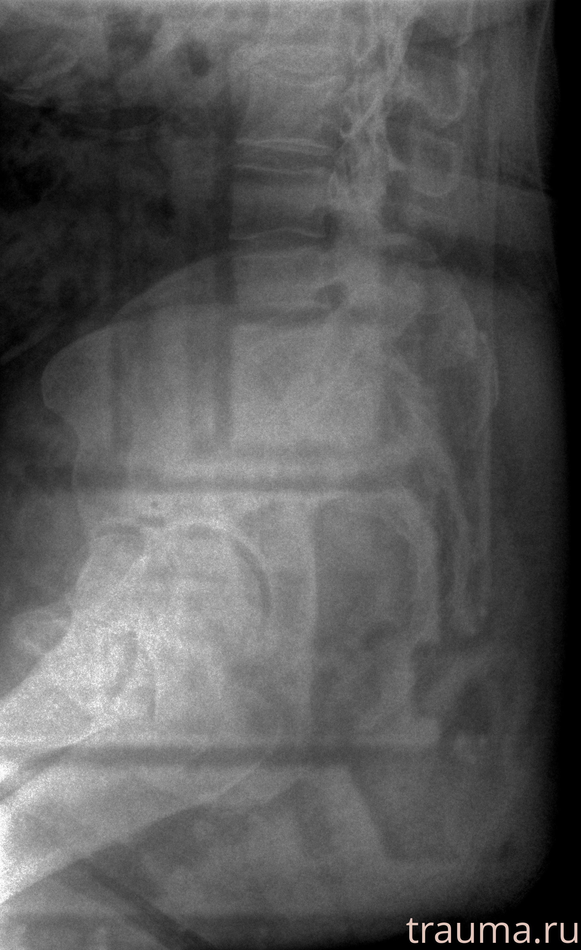 Рентген на дому: по вашему адресу приезжает врач-рентгенолог, травматолог-ортопед с мобильным рентгеновским аппаратом, проводит диагностику травмы или заболевания, делает необходимые рентгенограммы, дает рекомендации по дальнейшему лечению. Получить качественные снимки в домашних условиях возможно благодаря уникальной методике, разработанной МосРентген Центром для института  Склифосовского