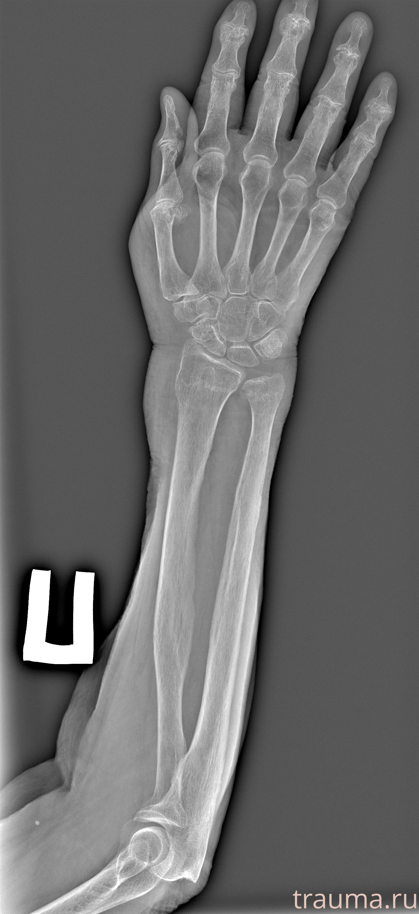 Рентген на дому: по вашему адресу приезжает врач-рентгенолог, травматолог-ортопед с мобильным рентгеновским аппаратом, проводит диагностику травмы или заболевания, делает необходимые рентгенограммы, дает рекомендации по дальнейшему лечению. Получить качественные снимки в домашних условиях возможно благодаря уникальной методике, разработанной МосРентген Центром для института  Склифосовского