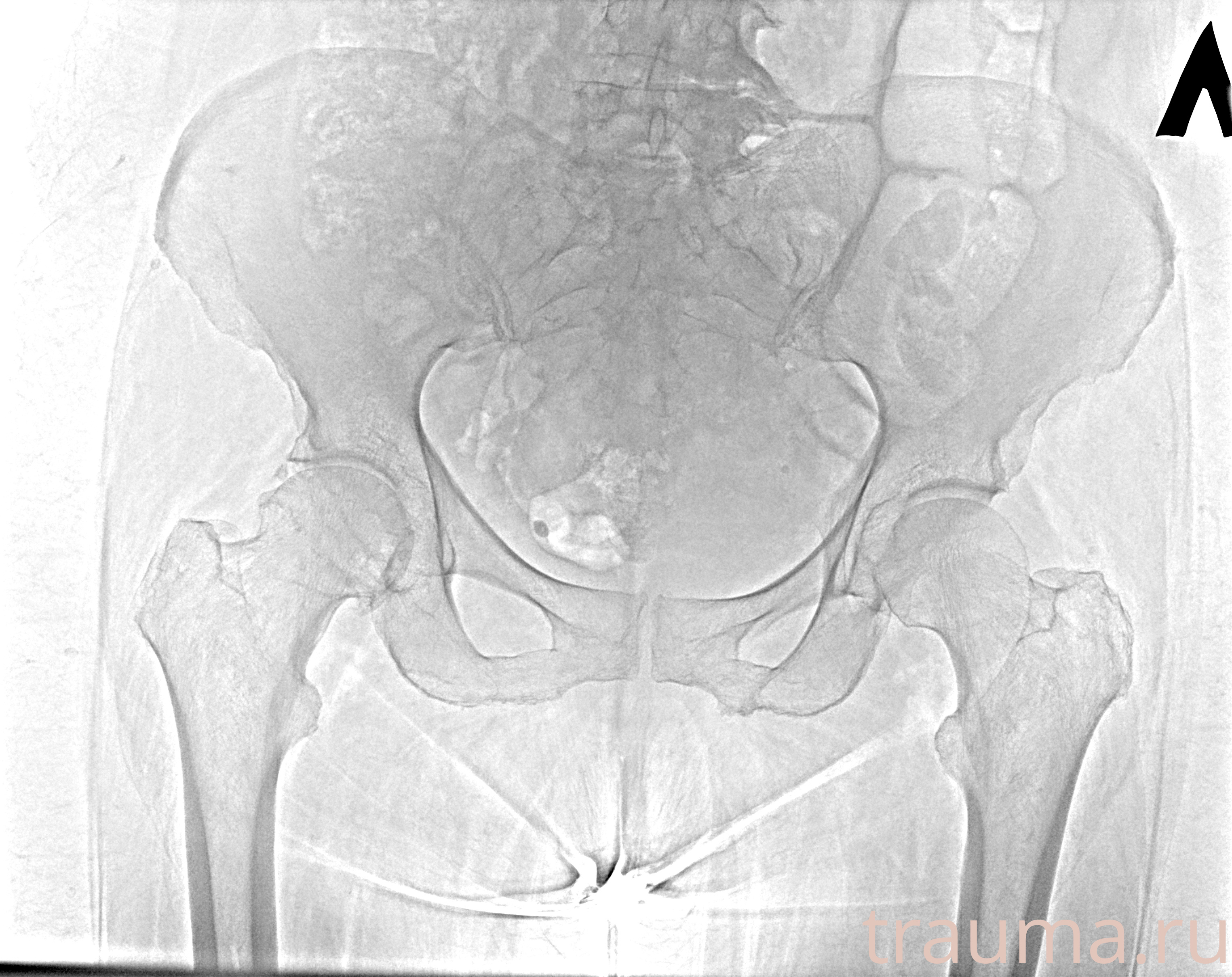 Рентген на дому: по вашему адресу приезжает врач-рентгенолог, травматолог-ортопед с мобильным рентгеновским аппаратом, проводит диагностику травмы или заболевания, делает необходимые рентгенограммы, дает рекомендации по дальнейшему лечению. Получить качественные снимки в домашних условиях возможно благодаря уникальной методике, разработанной МосРентген Центром для института  Склифосовского