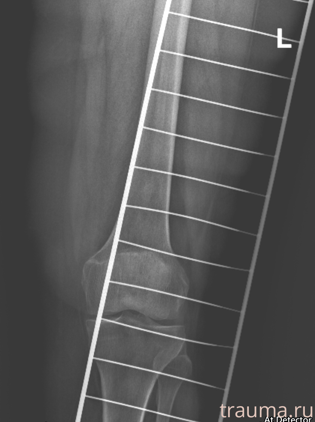 Рентген на дому: по вашему адресу приезжает врач-рентгенолог, травматолог-ортопед с мобильным рентгеновским аппаратом, проводит диагностику травмы или заболевания, делает необходимые рентгенограммы, дает рекомендации по дальнейшему лечению. Получить качественные снимки в домашних условиях возможно благодаря уникальной методике, разработанной МосРентген Центром для института  Склифосовского