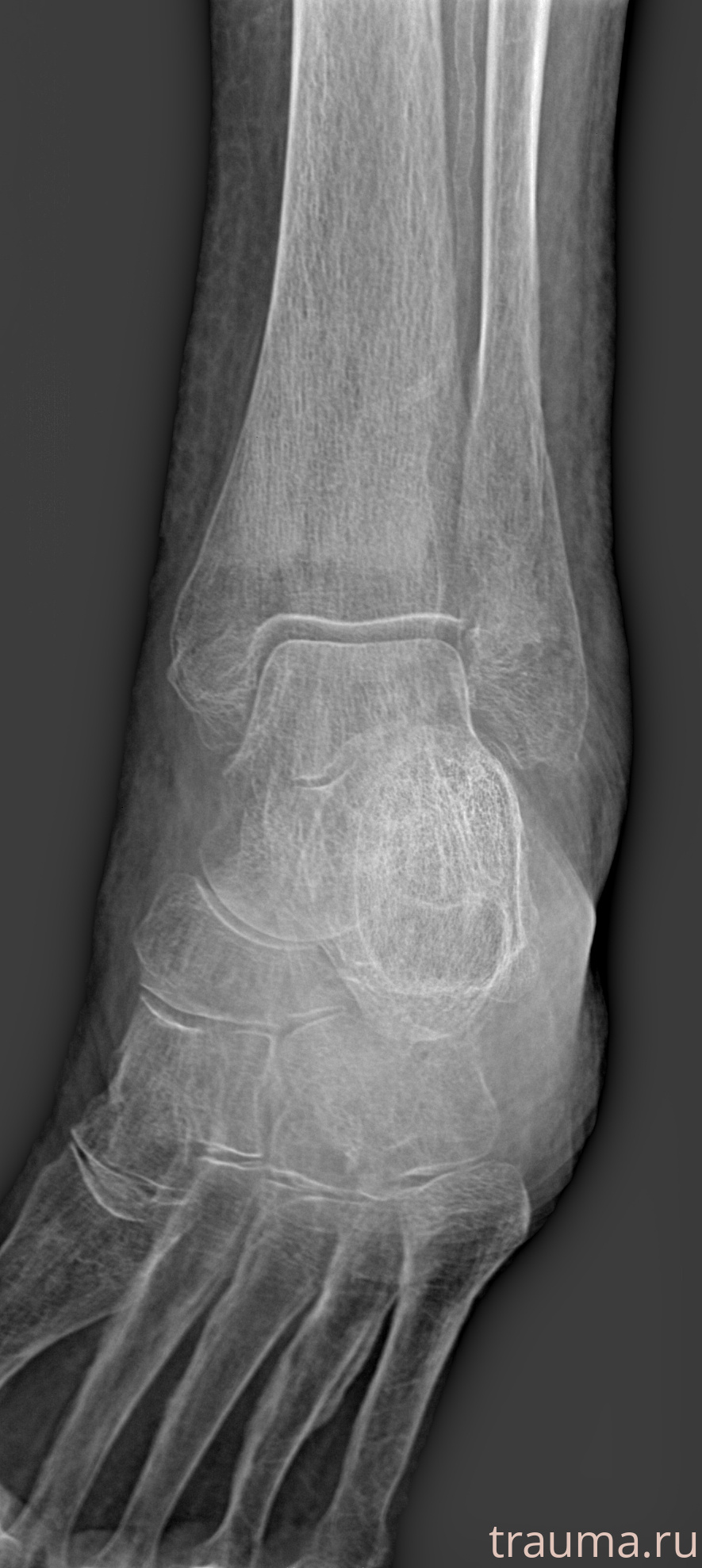 Рентген на дому: по вашему адресу приезжает врач-рентгенолог, травматолог-ортопед с мобильным рентгеновским аппаратом, проводит диагностику травмы или заболевания, делает необходимые рентгенограммы, дает рекомендации по дальнейшему лечению. Получить качественные снимки в домашних условиях возможно благодаря уникальной методике, разработанной МосРентген Центром для института  Склифосовского