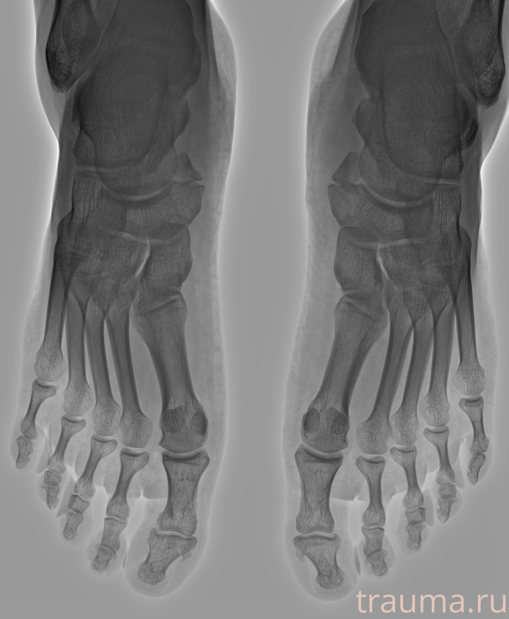 Рентген на дому: по вашему адресу приезжает врач-рентгенолог, травматолог-ортопед с мобильным рентгеновским аппаратом, проводит диагностику травмы или заболевания, делает необходимые рентгенограммы, дает рекомендации по дальнейшему лечению. Получить качественные снимки в домашних условиях возможно благодаря уникальной методике, разработанной МосРентген Центром для института  Склифосовского