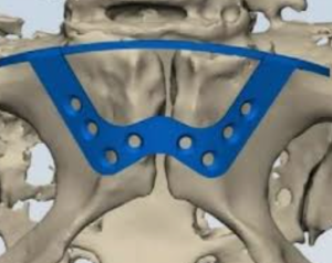 Современные технологии для малоинвазивной репозиции костей таза