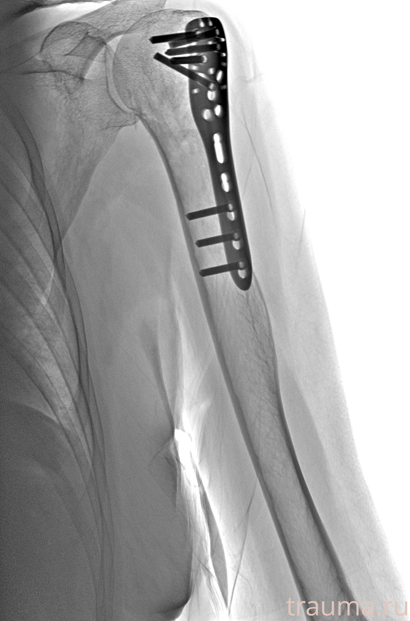 Рентген на дому: по вашему адресу приезжает врач-рентгенолог, травматолог-ортопед с мобильным рентгеновским аппаратом, проводит диагностику травмы или заболевания, делает необходимые рентгенограммы, дает рекомендации по дальнейшему лечению. Получить качественные снимки в домашних условиях возможно благодаря уникальной методике, разработанной МосРентген Центром для института  Склифосовского