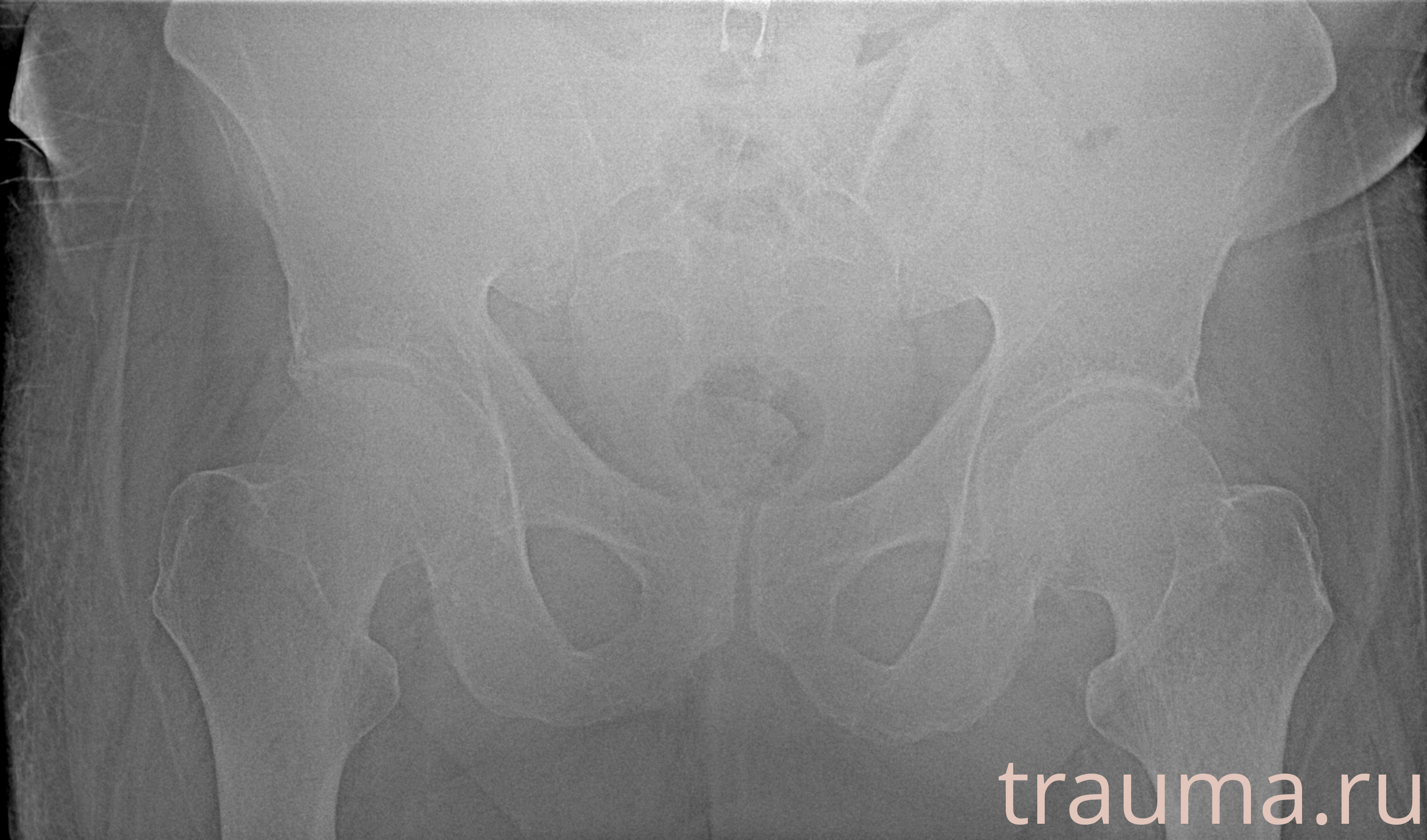 Рентген на дому: по вашему адресу приезжает врач-рентгенолог, травматолог-ортопед с мобильным рентгеновским аппаратом, проводит диагностику травмы или заболевания, делает необходимые рентгенограммы, дает рекомендации по дальнейшему лечению. Получить качественные снимки в домашних условиях возможно благодаря уникальной методике, разработанной МосРентген Центром для института  Склифосовского