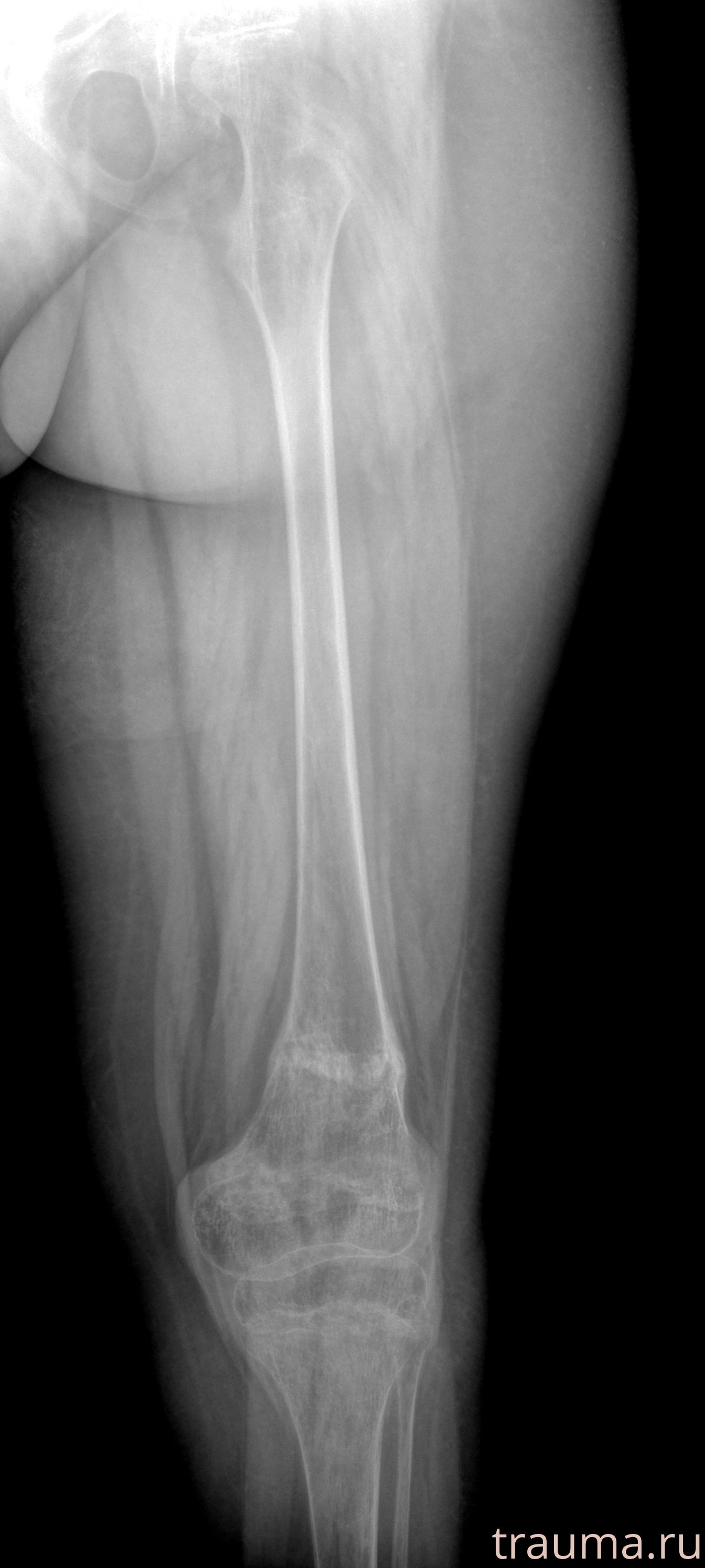 Рентген на дому: по вашему адресу приезжает врач-рентгенолог, травматолог-ортопед с мобильным рентгеновским аппаратом, проводит диагностику травмы или заболевания, делает необходимые рентгенограммы, дает рекомендации по дальнейшему лечению. Получить качественные снимки в домашних условиях возможно благодаря уникальной методике, разработанной МосРентген Центром для института  Склифосовского