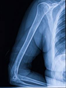 Современное состояние проблемы диагностики и лечения закрытых диафизарных переломов
плечевой кости, осложненных нейропатией лучевого нерва