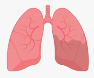Фиброз легких после перенесенных воспалительных заболеваний легких