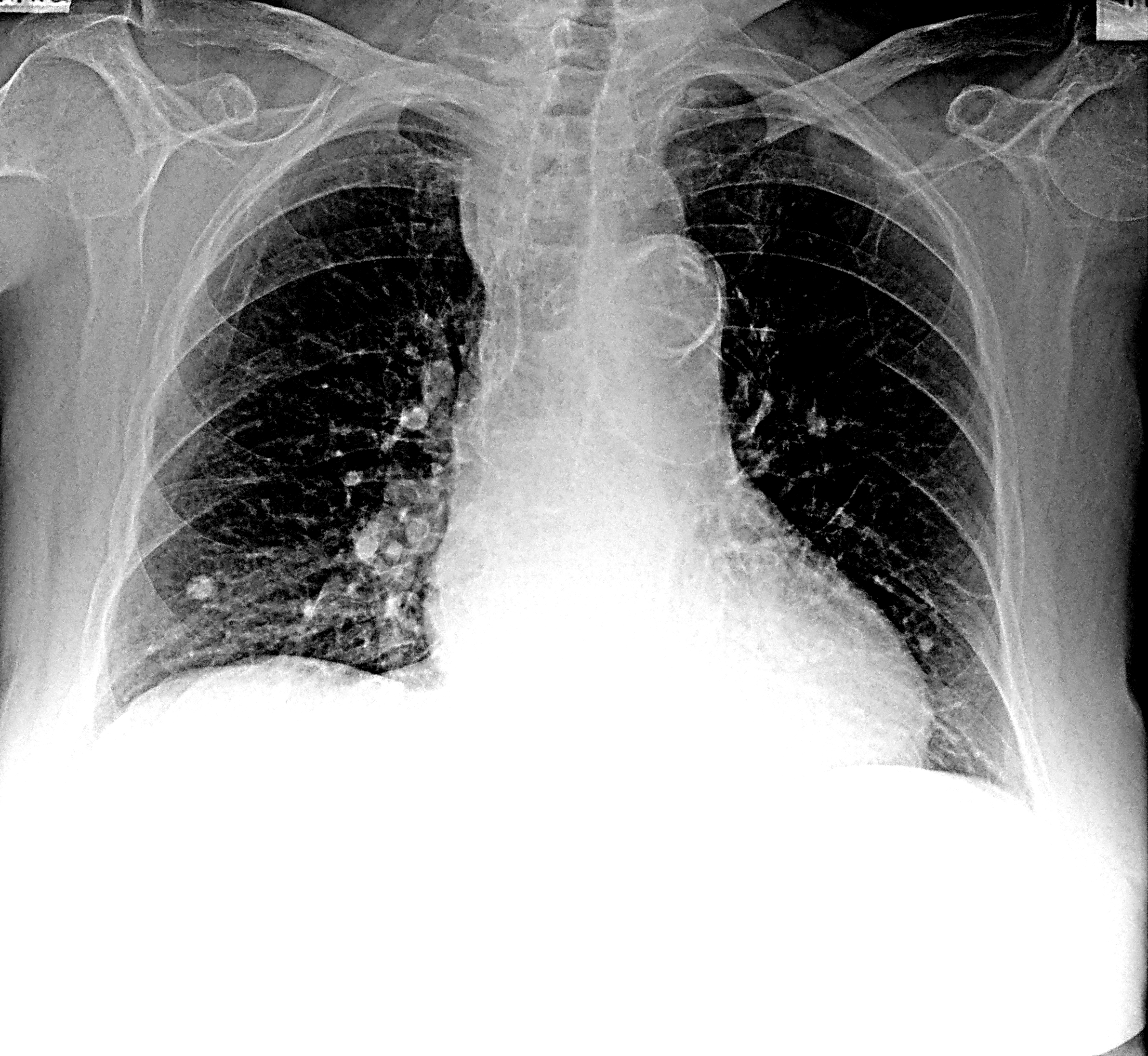 Поражение легких при коронавирусе фото рентгена