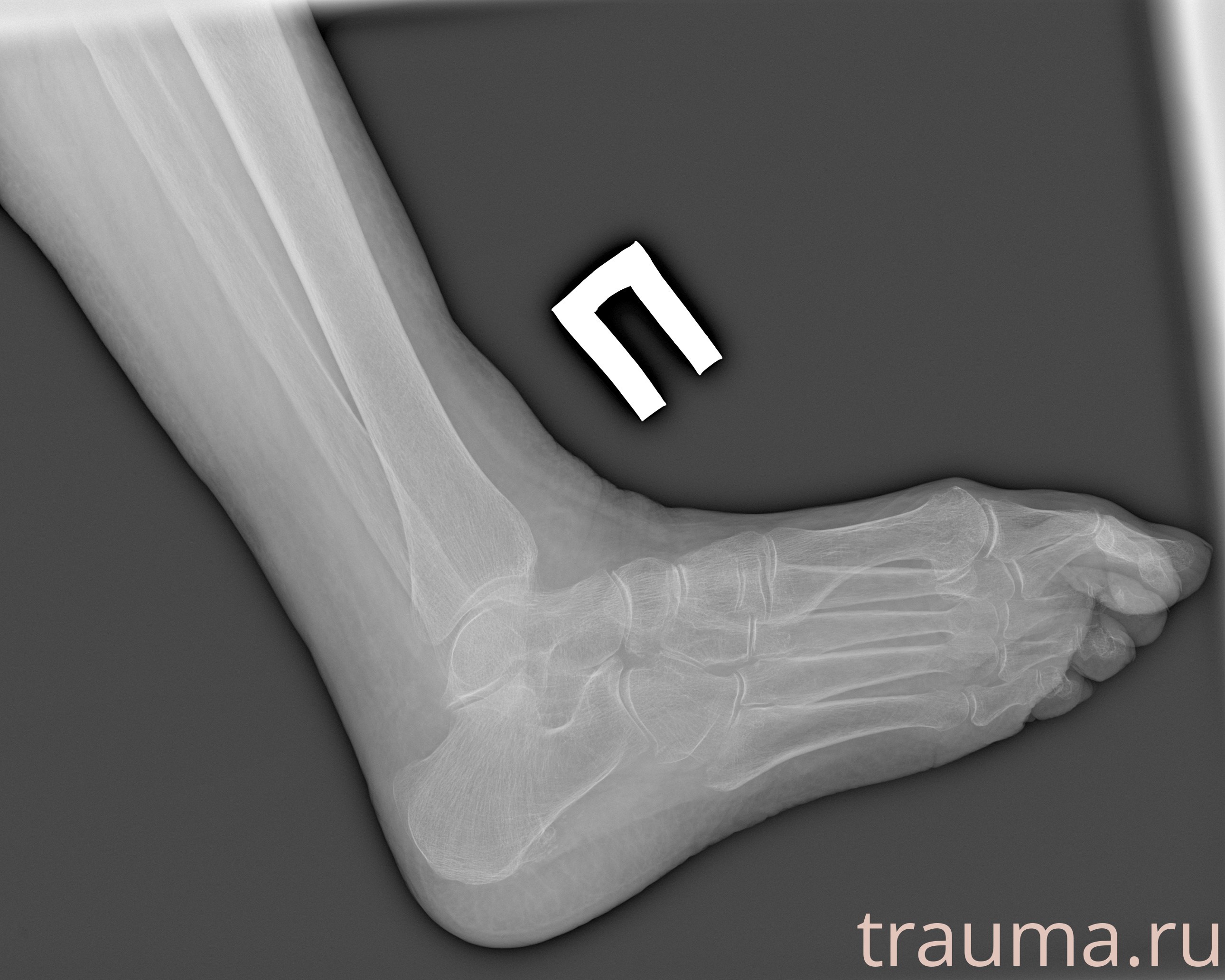 Рентген на дому: по вашему адресу приезжает врач-рентгенолог, травматолог-ортопед с мобильным рентгеновским аппаратом, проводит диагностику травмы или заболевания, делает необходимые рентгенограммы, дает рекомендации по дальнейшему лечению. Получить качественные снимки в домашних условиях возможно благодаря уникальной методике, разработанной МосРентген Центром для института  Склифосовского