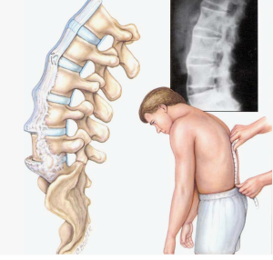 Редкий случай тяжелой деформации у пациента с анкилозирующим спондилитом

