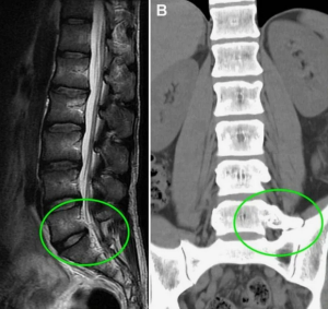 Особенности клинических проявлений, диагностики и лечения синдрома бертолотти (клинический случай)