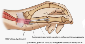 Болезнь Де Кервена  (этиология , патогенез,  диагностика лечения). Часть  I