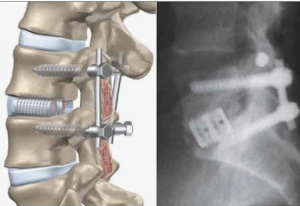 Лечение посттравматического поясничного кифоза с использованием многоуровневой остеотомии понте и заднего спондилодеза: клинический опыт