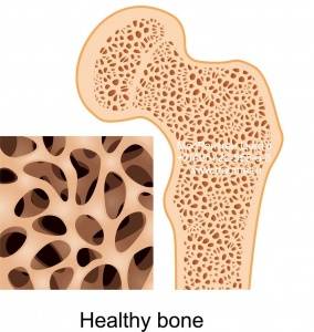 Как выглядит кость при остеопорозе
