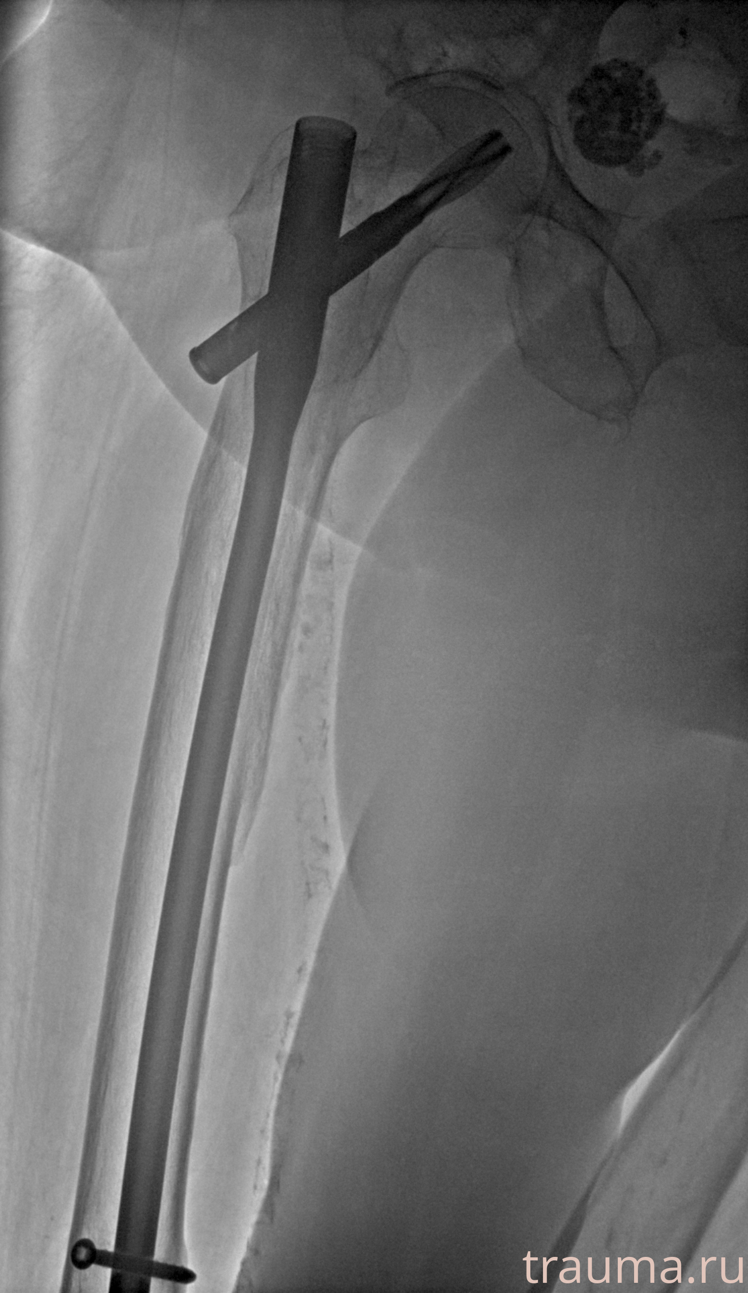 Рентген на дому: по вашему адресу приезжает врач-рентгенолог, травматолог-ортопед с мобильным рентгеновским аппаратом, проводит диагностику травмы или заболевания, делает необходимые рентгенограммы, дает рекомендации по дальнейшему лечению. Получить качественные снимки в домашних условиях возможно благодаря уникальной методике, разработанной МосРентген Центром для института  Склифосовского