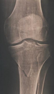 Переломы мыщелков большеберцовой кости: современные подходы к лечению и хирургические доступы (обзор литературы) 