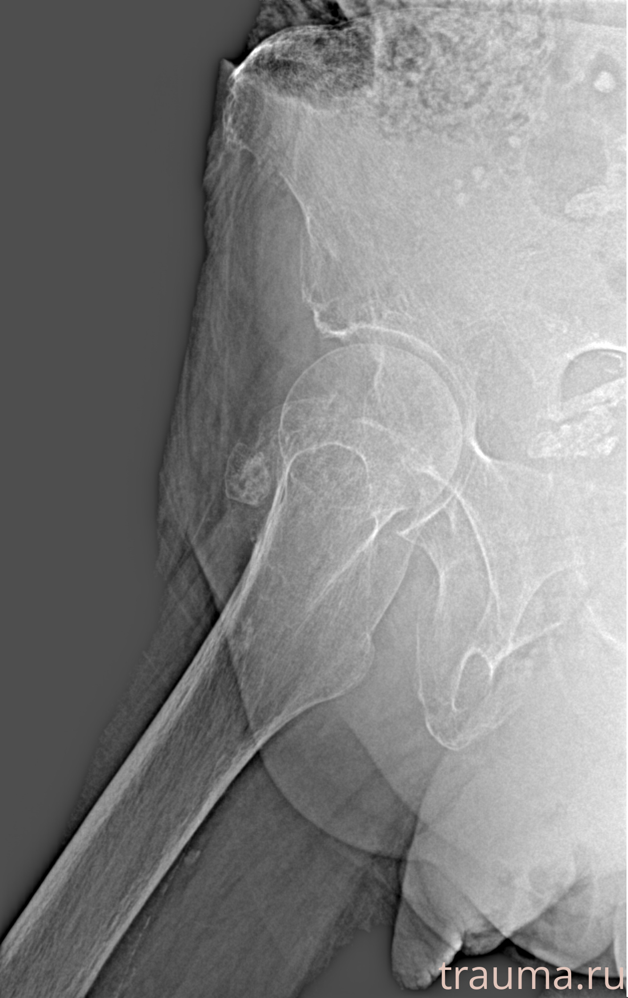 Рентген на дому: по вашему адресу приезжает врач-рентгенолог, травматолог-ортопед с мобильным рентгеновским аппаратом, проводит диагностику травмы или заболевания, делает необходимые рентгенограммы, дает рекомендации по дальнейшему лечению. Получить качественные снимки в домашних условиях возможно благодаря уникальной методике, разработанной МосРентген Центром для института  Склифосовского