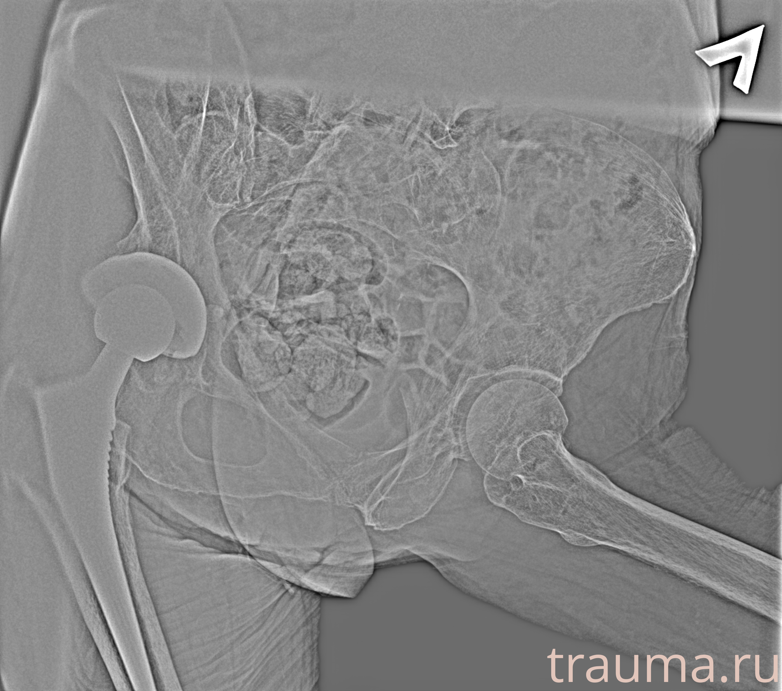 Рентген на дому: по вашему адресу приезжает врач-рентгенолог, травматолог-ортопед с мобильным рентгеновским аппаратом, проводит диагностику травмы или заболевания, делает необходимые рентгенограммы, дает рекомендации по дальнейшему лечению. Получить качественные снимки в домашних условиях возможно благодаря уникальной методике, разработанной МосРентген Центром для института  Склифосовского