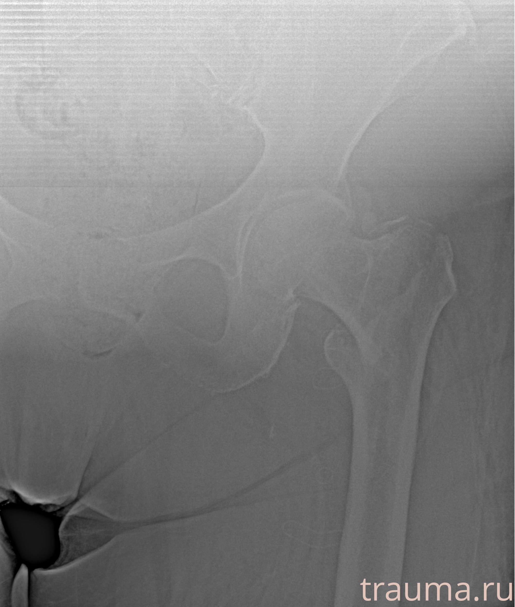 Рентген на дому: по вашему адресу приезжает врач-рентгенолог, травматолог-ортопед с мобильным рентгеновским аппаратом, проводит диагностику травмы или заболевания, делает необходимые рентгенограммы, дает рекомендации по дальнейшему лечению. Получить качественные снимки в домашних условиях возможно благодаря уникальной методике, разработанной МосРентген Центром для института  Склифосовского