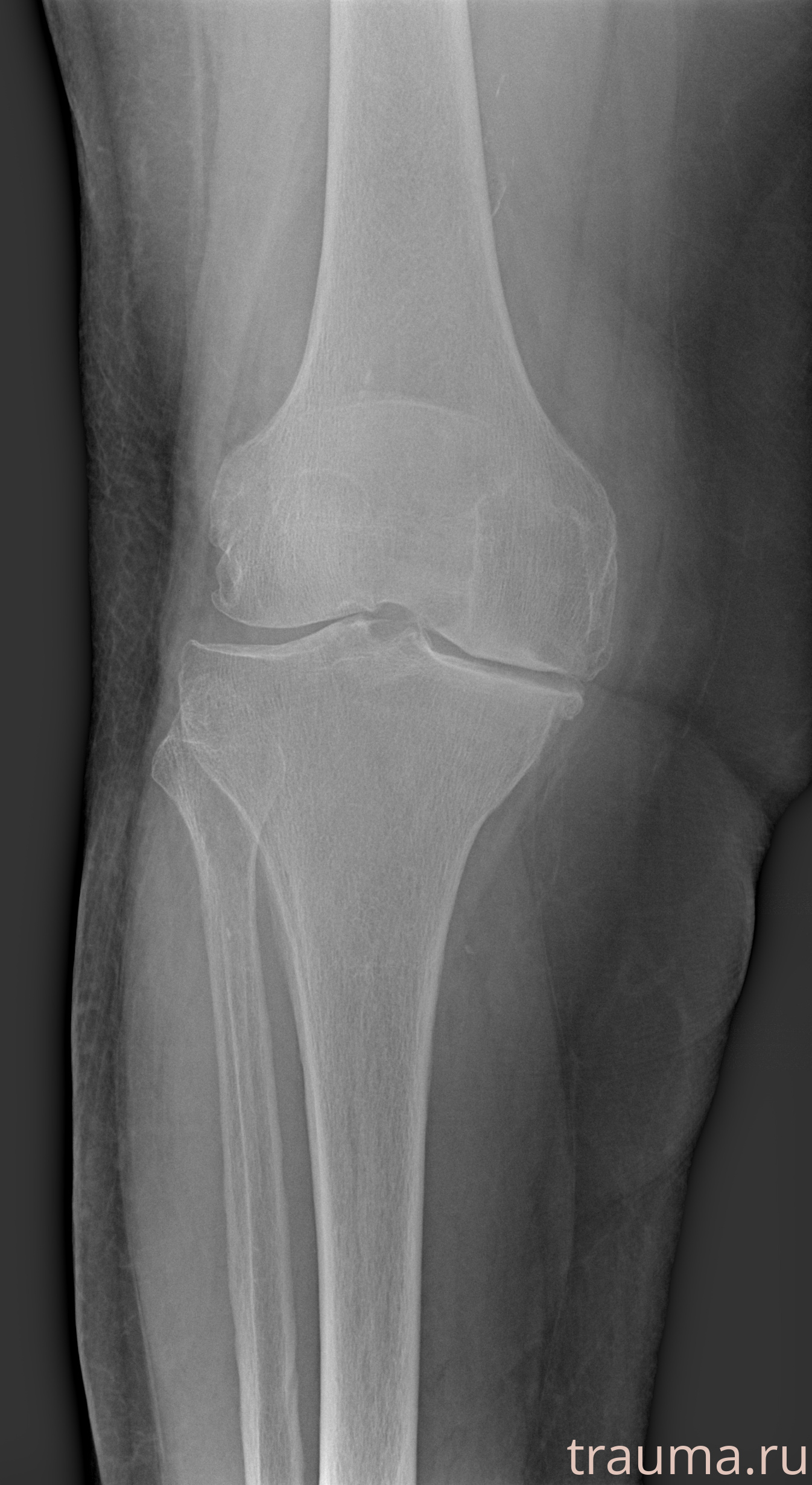 Рентген на дому: по вашему адресу приезжает врач-рентгенолог, травматолог-ортопед с мобильным рентгеновским аппаратом, проводит диагностику травмы или заболевания, делает необходимые рентгенограммы, дает рекомендации по дальнейшему лечению. Получить качественные снимки в домашних условиях возможно благодаря уникальной методике, разработанной МосРентген Центром для института  Склифосовского