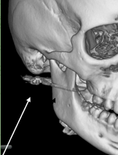 Школьник получил пулю в лицо во время игры