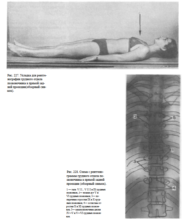 Укладка при рентгенография грудного отдела позвоночника укладка