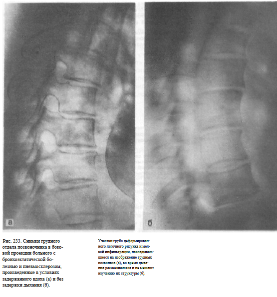Укладки при рентгенографии грудного отдела позвоночника