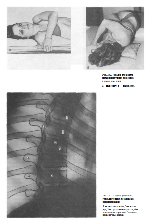 Укладка на рентген поясничного отдела позвоночника по кишковскому