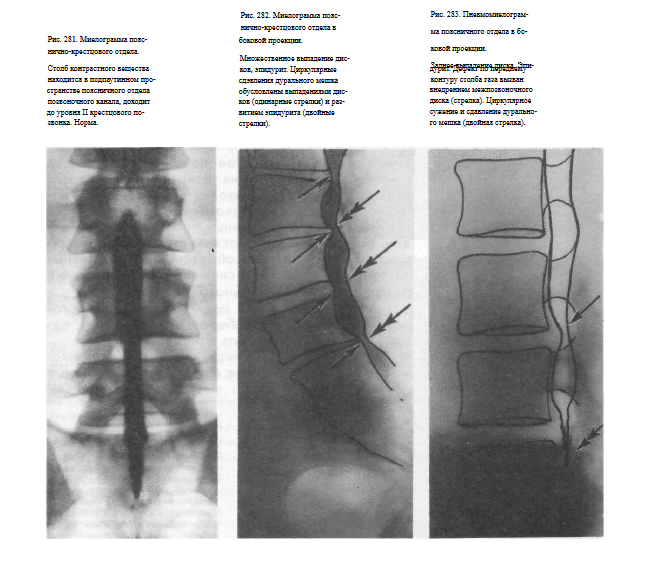 Дуральный корешок. Дуральный мешок спинного мозга. Дуральный мешок позвоночника деформирован. Дуральный мешок позвоночника строение. Деформация дурального мешка поясничного отдела позвоночника.