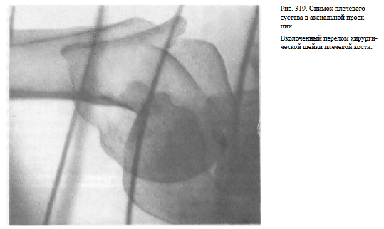 Проекции рентгена плечевого сустава