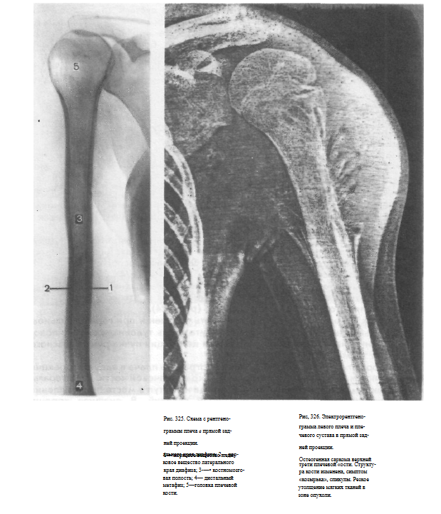 Рентген плечевого сустава при вывихе