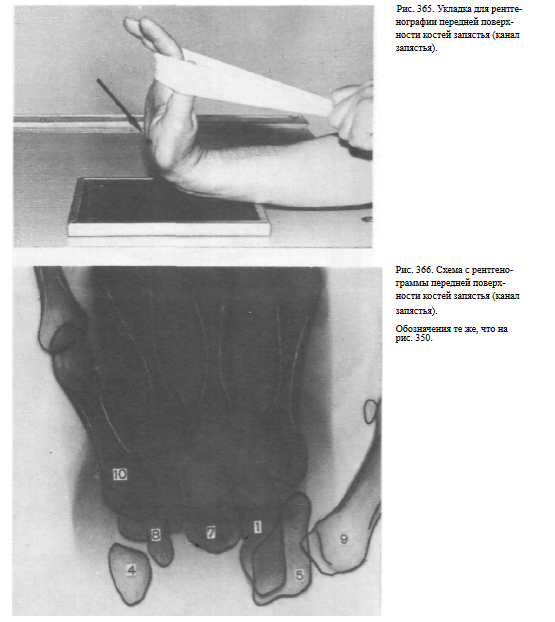 Оптимальная проекция для выявления перелома ладьевидной кости запястья