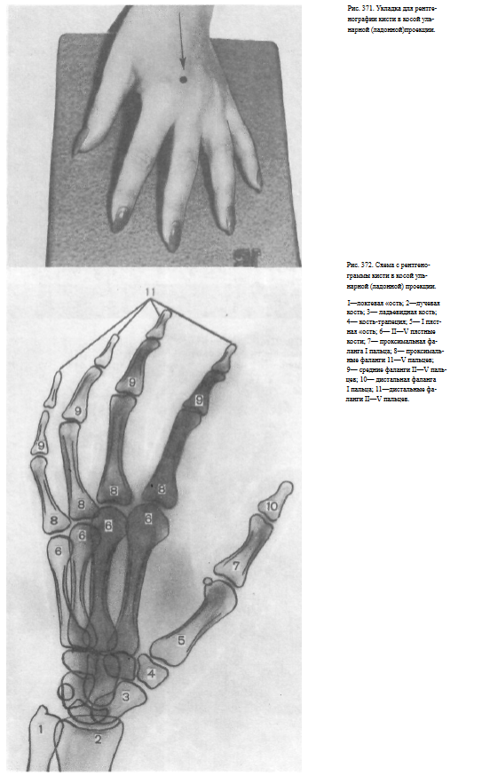 Оптимальная проекция для выявления перелома ладьевидной кости запястья