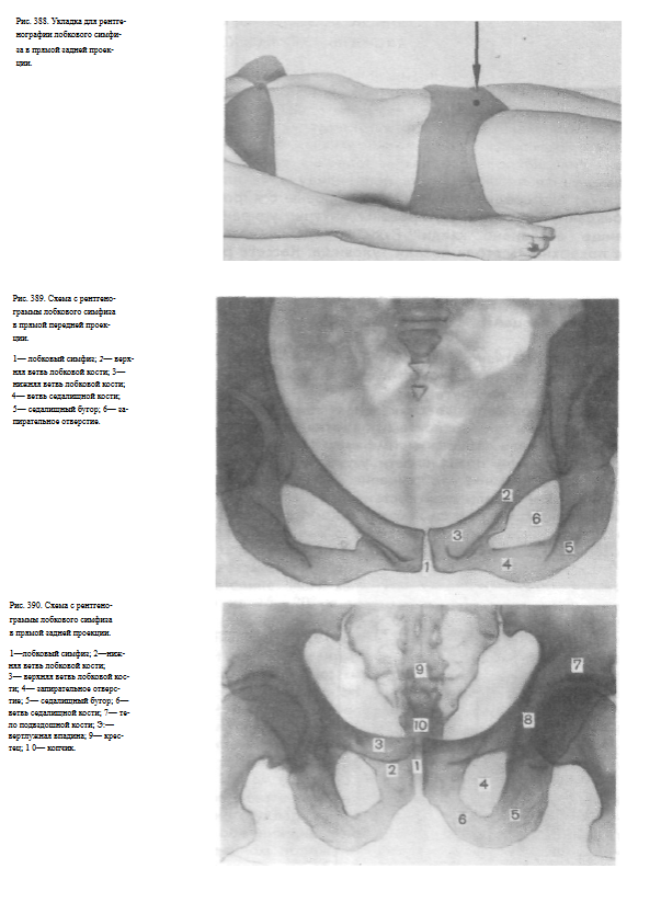 Снимок лобкового симфиза в аксиальной проекции. Расширение таза при беременности