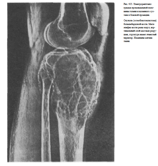 Рентген описание перелома голени