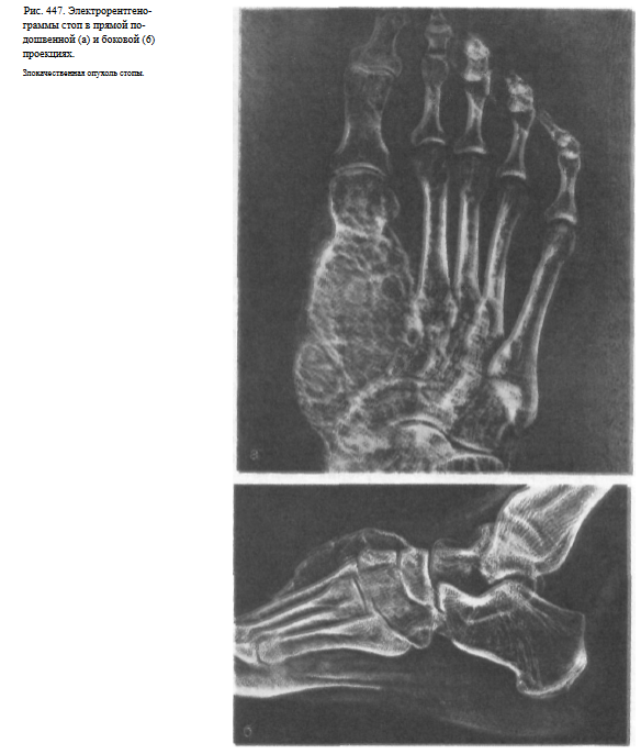 Рентгенограммы костей при переломах пальцев стоп